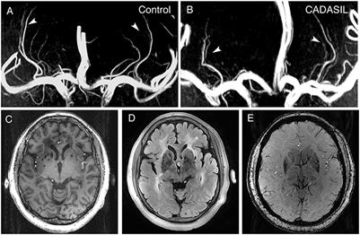 Lenticulostriate Arteries and Basal Ganglia Changes in Cerebral Autosomal Dominant Arteriopathy With Subcortical Infarcts and Leukoencephalopathy, a High-Field MRI Study